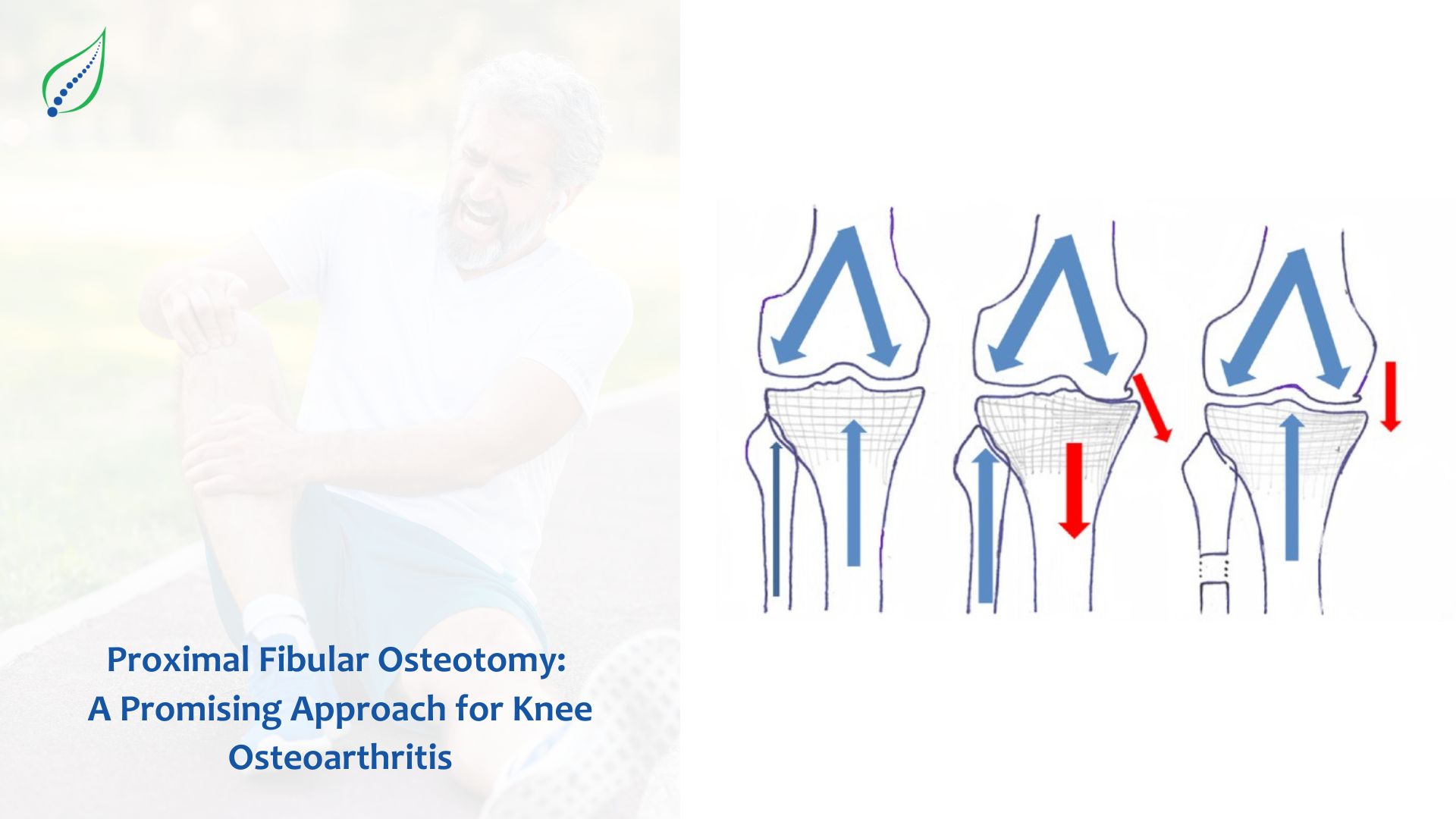 Proximal Fibular Osteotomy